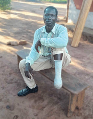 A man sites on a bench with one foot on the ground and his other leg on the bench showing his amputated portion of his lower leg in a sock.