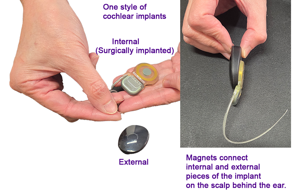 cochlear-implant-illustration-lead